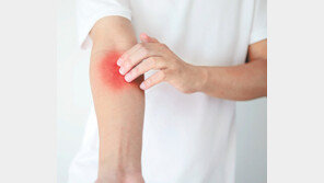 “샤워는 최대한 짧게… 가려울 땐 2분 정도만 참아보세요” 