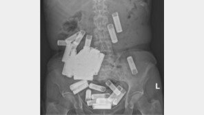 복통 호소 60대女, 수술한 의사 충격…위장서 건전지 55개 발견