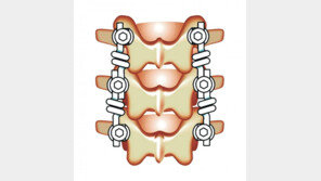 “추간공확장술부터 복잡한 수술까지 척추질환 토털 시스템 구축”