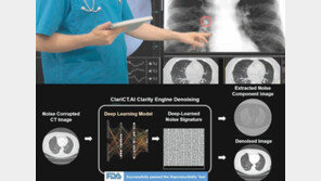초저선량 CT로 진단하는 인공지능 의료영상솔루션