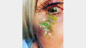 깜빡 잊고 잠들었다?…한쪽 눈에서 23개의 렌즈 빼낸 여성