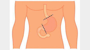 위 점막이 장 점막으로 변하는 ‘장상피화생’, 위암 발생률 10배 높인다