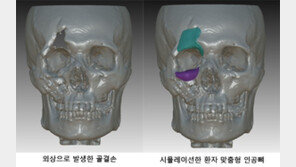 ‘3D 프린터’로 얼굴 뼈도 만드는 시대…“손상부위 이식 성공”