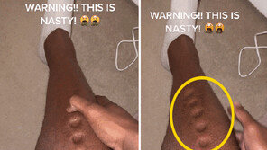 손가락으로 피부 누르자 ‘움푹’…올림픽 국대가 앓은 이 병은? (영상)