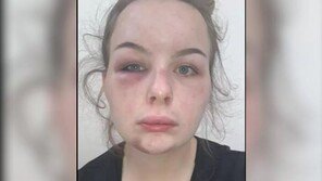 “亞남성이 성폭행” 피멍 사진 올린 英여성, 전부 자작극이었다