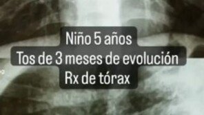 “석 달째 기침”…5살 아이 폐서 발견된 3cm 금속 스프링 