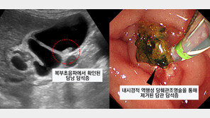 [100세건강] 명치 심하게 아프다면 담석증 의심…식습관 개선해야