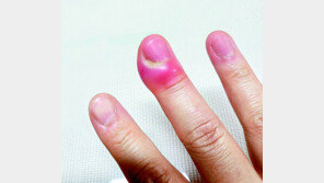 “손톱 주변 거스러미 함부로 뜯지 마세요” 