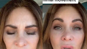 20년 맞던 보톡스 중단했더니…美 여성, 근위축증 앓아