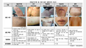 엠폭스 확진자 3명 늘어 누적 16명…국내전파 추정