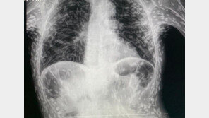 몸속 기생충 수백마리…의사 경악케한 엑스레이 한 장