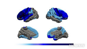 우울증 환자, MRI보니…“정서조절 담당 뇌 주름 적었다”