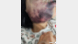 ‘부산 노래주점 묻지마 폭행’ 피해 여성 “꿈 속에 가해자 나와 공포”