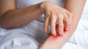 교복 밖으로 드러난 아토피… 스트레스로 증상 악화되기도 