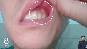 “수술 잘됐다더니”…50일만에 발견한 잇몸 속 썩은 거즈