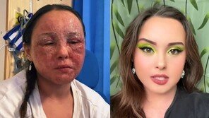 메이크업 틱톡女 과거 ‘습진’ 공개…현재는 완치돼