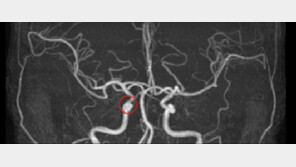 빅데이터-인공지능으로 뇌동맥류 의심 부위 찾는다[바이오헬스케어 로그인]