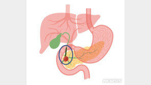 노랗게 변한 얼굴색, 황달?…“췌장암·담관암 신호일수도”