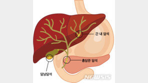 “속이 더부룩” 소화제 먹었는데…응급실 가보니 담석증