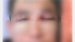 강남 성형외과서 눈밑지방 수술받은 50대…하루만에 실명