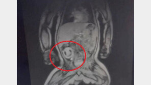 생후 4개월 中 남아 뱃속에 ‘기생 태아’ 발견…‘충격’