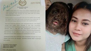 ‘늑대인간 증후군’ 2살 여아, 말레이시아 공주 된다