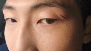 방탄소년단 RM, 눈썹 밑 깊은 상처 ‘깜짝’…눈물 글썽