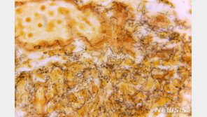 美 매독 가지고 태어난 아이 급증…10년동안 11배↑