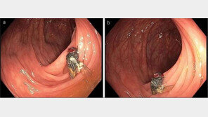 대장 내시경에 형태 온전한 파리가…“미스터리한 일”