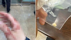 “봉투 안 준다고 폭행당해…치아 5개 깨졌다” 마트 사장의 토로
