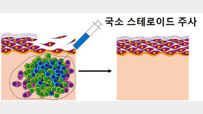 ‘천포창’ 만성 물집 새 치료법 제시