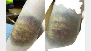 “피멍들때까지 맞았다”…‘무료과외’ 받던 수험생이 선생에게 당한일