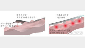 실명환자 희망될까…“망막상처 최소화” 인공망막 개발