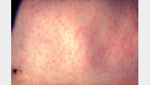 ‘전파력 최강’ 홍역에 유럽 비상…“해외여행 전 접종해야”