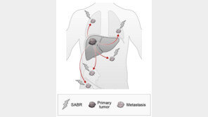 간암 부위에 고선량 방사선 쏴 치료… “효과-안전성 높아”