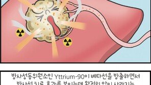 [만화 그리는 의사들]〈315〉간암의 치료-방사선색전술