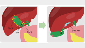 낯선 담낭 질환, 정확하게 알고 빠르게 치료해야