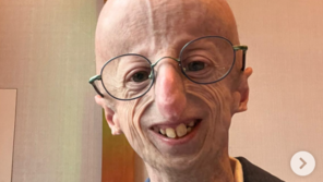 세계에서 가장 오래 산 28세 조로증 환자, 끝내 숨져