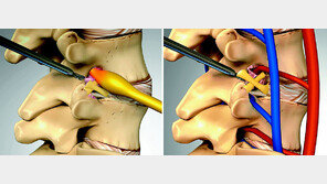 “증상-부위 다양한 척추 통증엔 추간공확장술이 가장 효과적”