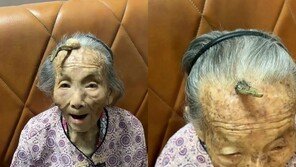 107세 할머니 이마에 ‘10㎝ 뿔’ 났다…“장수 상징인가?”