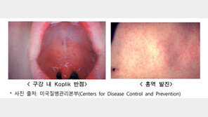 “해외여행 시 ‘홍역’ 주의”…홍역 환자 5년 만에 최대