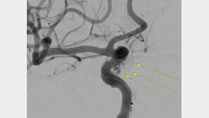 치사율 50% 뇌 지주막하 출혈…“신속한 진단·치료 이뤄져야”