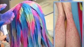 “엑소처럼 해주세요”…무지개 염색한 20대女 신장병 걸렸다