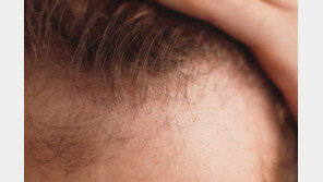 스테비아, 탈모인의 희망 되나? 미녹시딜과 ’찰떡궁합’