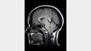 女, 치매 위험 두 배 높지만… 뇌 위축은 男이 더 심해