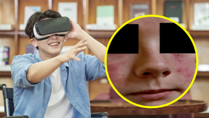 VR기기 쓰고 게임했더니 얼굴에 붉은 반점…‘이것’ 때문이었다