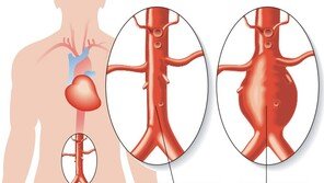 ‘조용한 시한폭탄’ 복부 대동맥류…13년간 3배 급증, 왜?