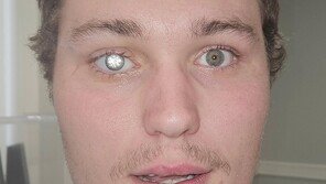 2캐럿 다이아몬드 삽입…세상에서 가장 비싼 눈 가진 남성