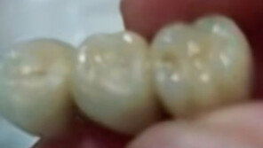 딤섬·소시지서 인공치아 ‘툭’…“사람 고기 재료로 썼나” 中 발칵