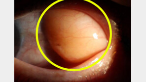 “눈 흰자 튀어나온 혹” 그냥 둬도 괜찮을까?